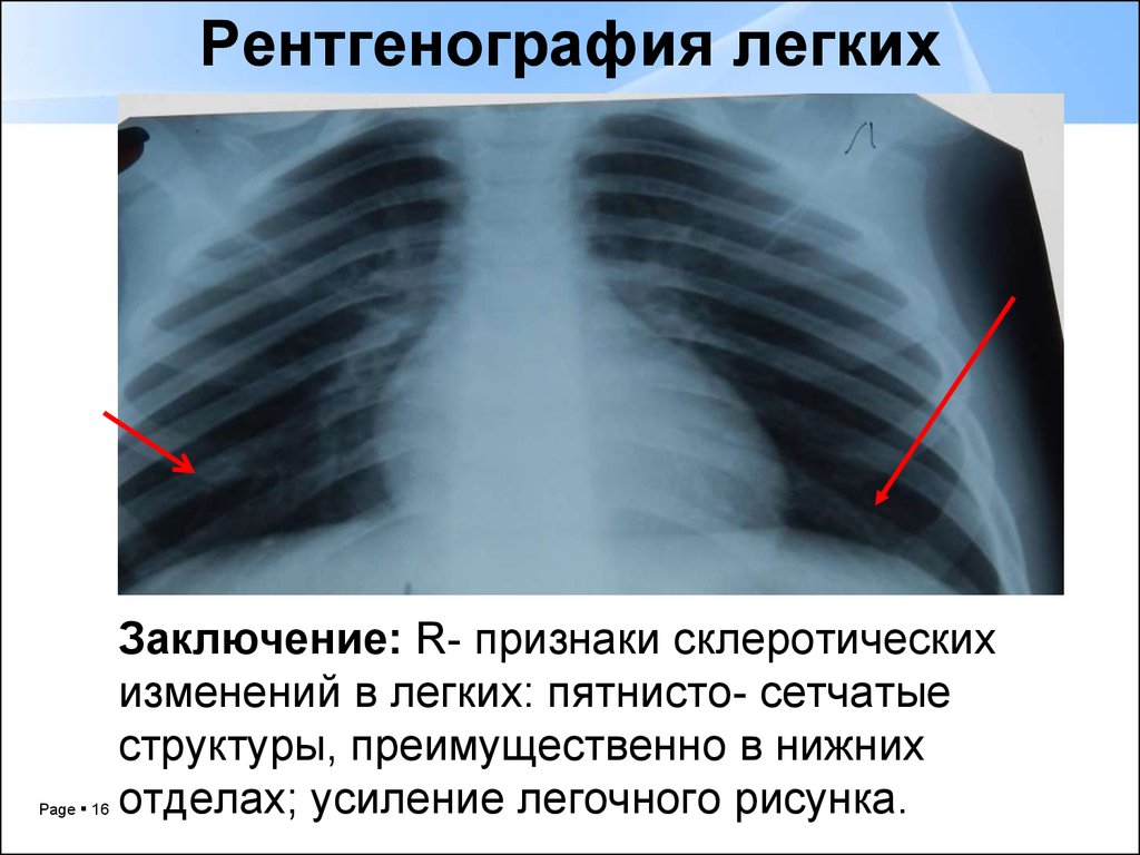 Обогащение легочного рисунка на рентгене у ребенка