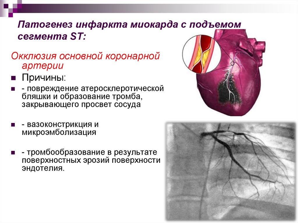 Тромбоз коронарных артерий. Механизм развития острого инфаркта миокарда. Коронарография при инфаркте миокарда. Инфаркт миокарда окклюзия артерий. Инфаркт окклюзия артерии.
