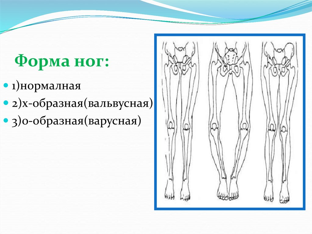 Ноги формой х. Форма ног. Формы ног и их названия.