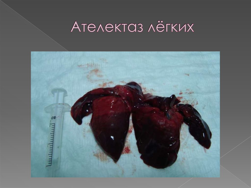 Ателектаз лёгких