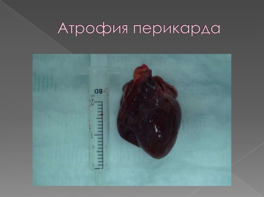 Атрофия перикарда