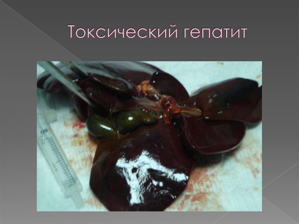 Токсический гепатит