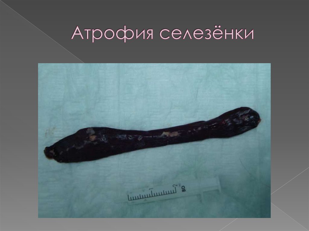 Атрофия селезёнки