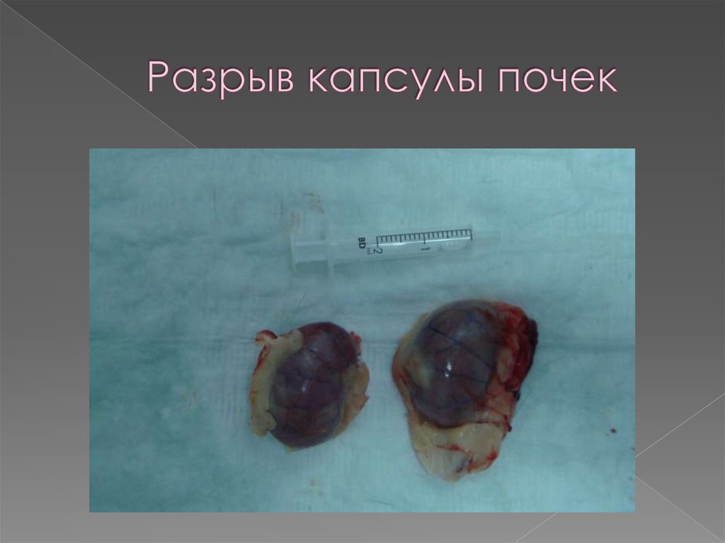 Разрыв капсулы почек