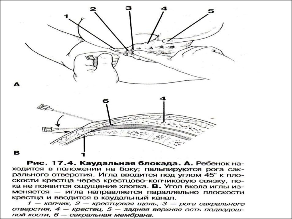 Регионарная анестезия у детей презентация