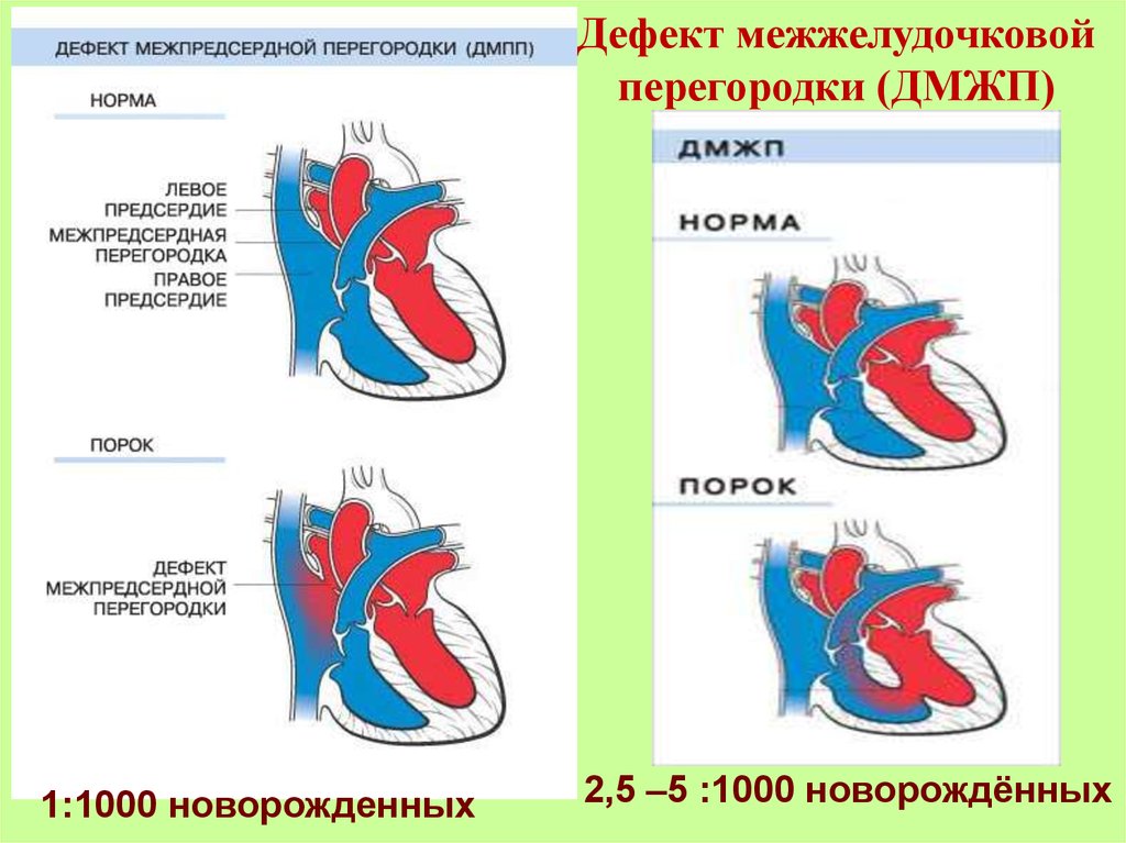 Дефект межжелудочковой перегородки презентация