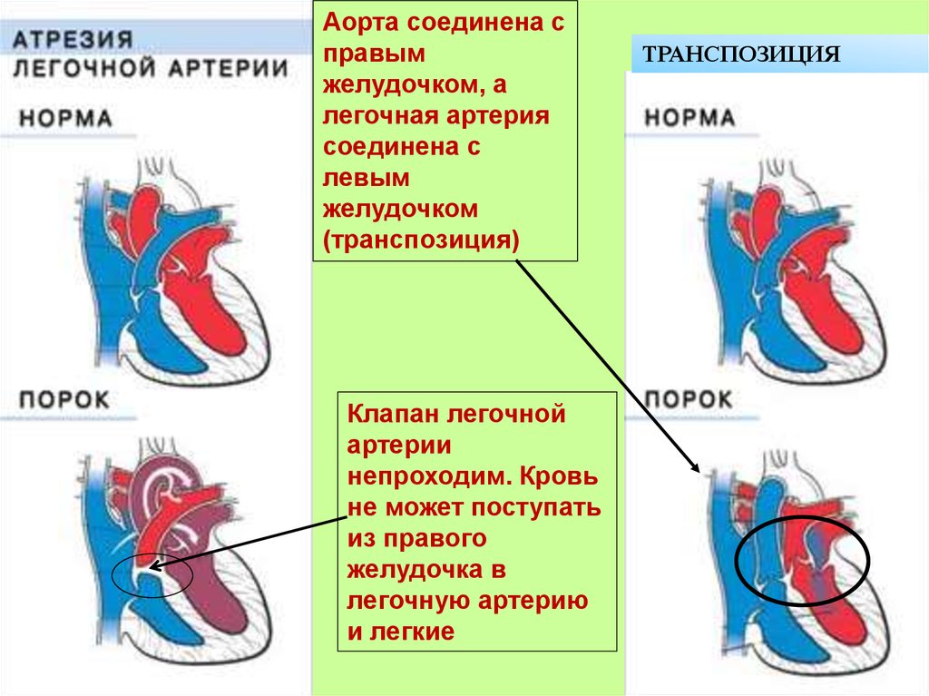 Вид легочной артерии. Атрезия клапана легочной артерии. Типы атрезии легочной артерии. Атрезия легочной артерии 1 Тип ДМЖП. Атрезия легочной артерии 1-2 Тип.