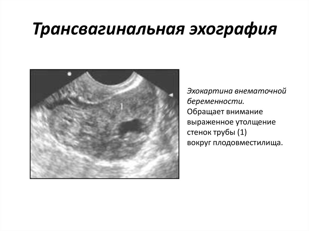 Трансвагинальное узи на ранних сроках беременности