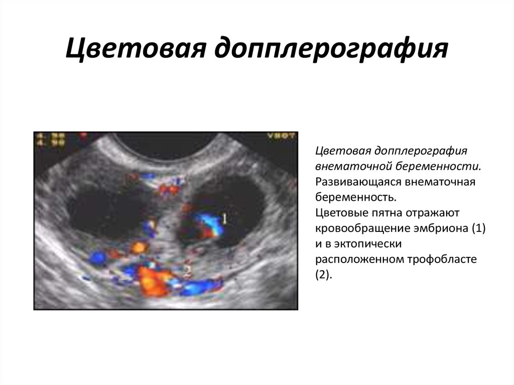 Тянет яичник при беременности на ранних