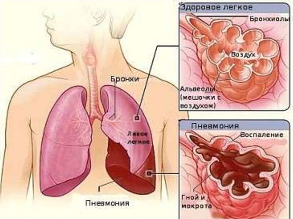 Воспаление легких пути воспаление. Признаки пневмонии у взрослого.