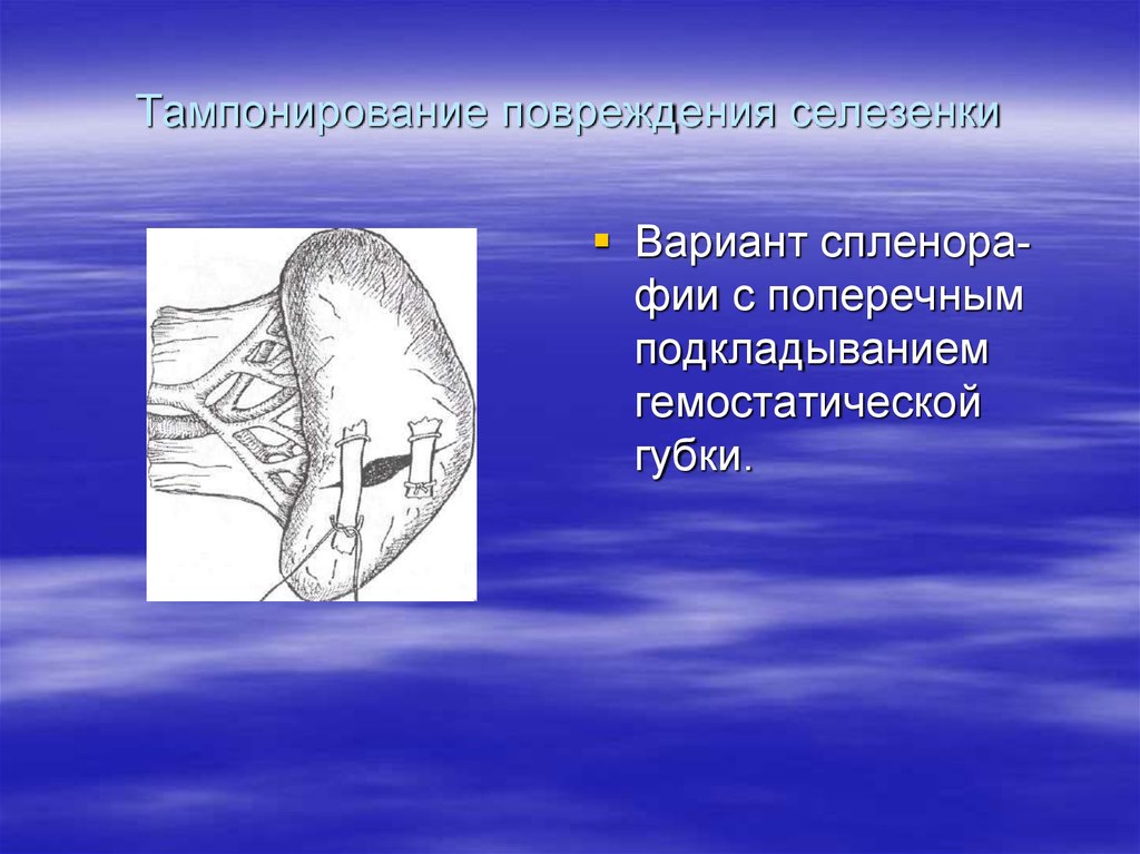 Операции на селезенке. Тампонирование ранения. Кровотечение селезенки. Гемостатическое тампонирование селезенки.