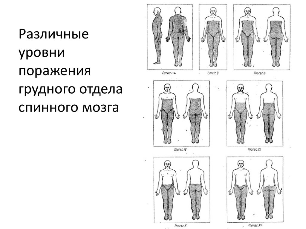 Уровень поражения. Симптомы поражения спинного мозга на разных уровнях неврология. Синдромы поражения спинного мозга на различных уровнях. Синдром поражения спинного мозга грудной уровень. Синдром поперечного поражения спинного мозга на различных уровнях.