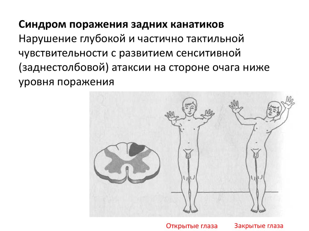 Синдромы нарушения чувствительности. Синдром поражения задних канатиков. Синдром поражения боковых канатиков. Поражение задних канатиков спинного мозга. Синдром поражения бокового канатика спинного мозга.