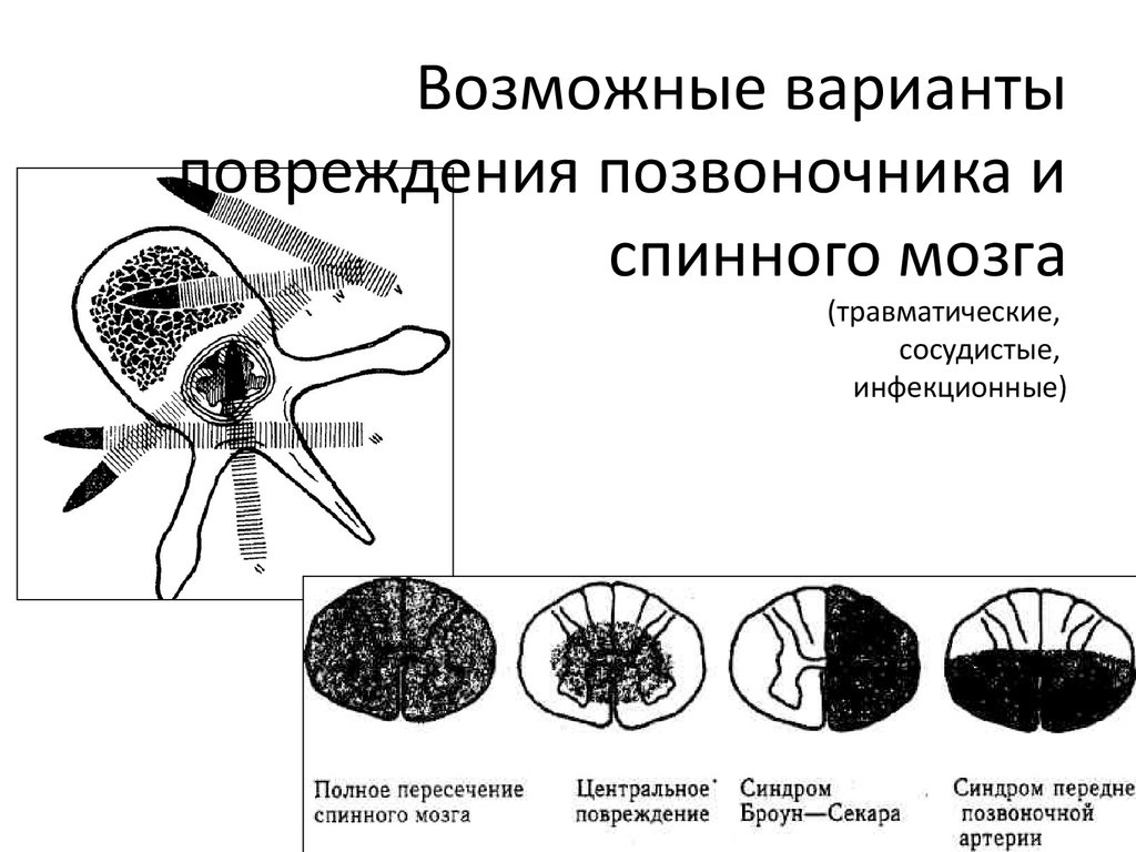 Полное поражение. Поражение передних Корешков спинного мозга. Синдромы поражения Корешков спинного мозга. Синдром интрамедуллярного поражения спинного мозга. Поражение переднего корешка спинного мозга.