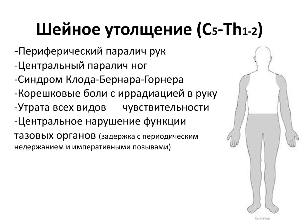 Полное поражение. Симптомы поражения шейного утолщения спинного мозга. Синдромы поражения шейного утолщения спинного. Поражение шейного утолщения спинного мозга. Синдром поражения шейного утолщения.