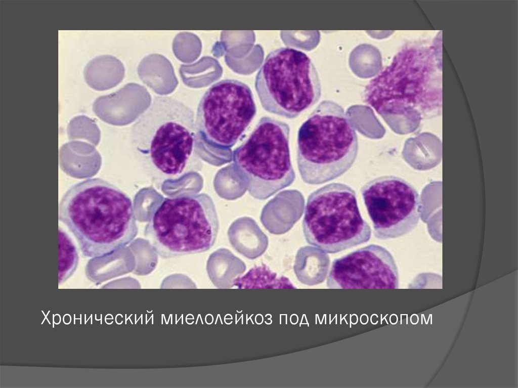 Картина крови при миелобластном лейкозе