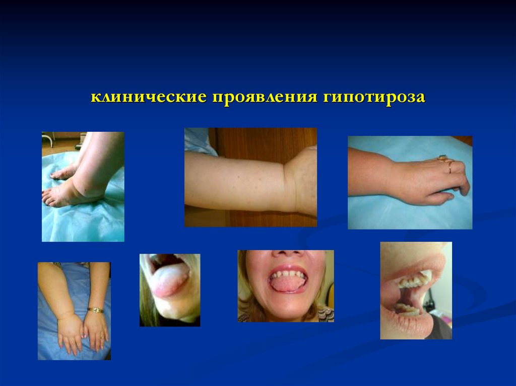 клинические проявления гипотироза