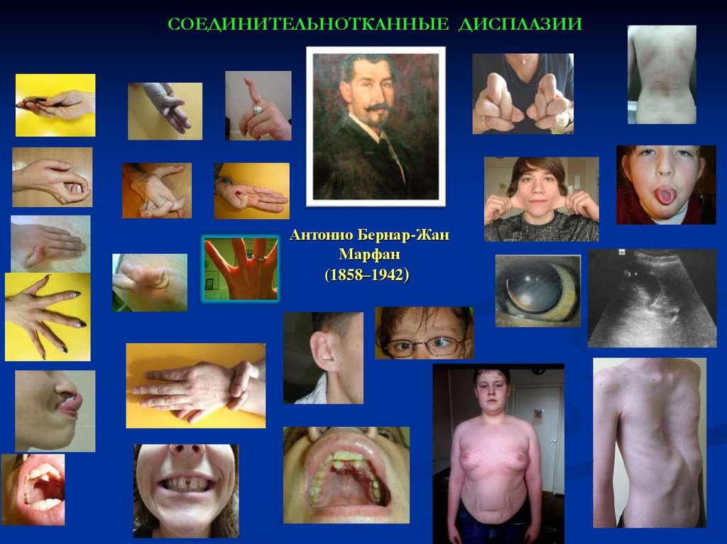 СОЕДИНИТЕЛЬНОТКАННЫЕ ДИСПЛАЗИИ