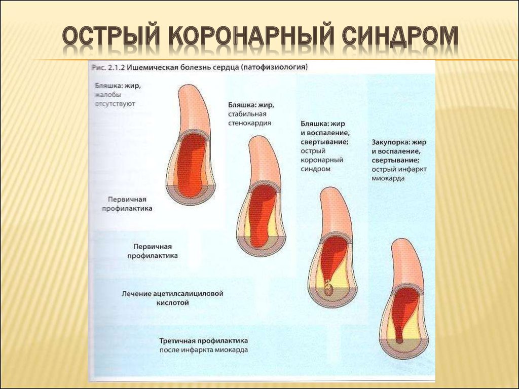 Коронарные осложнения