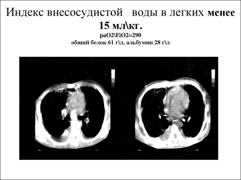 Вода в легких. Индекс внесосудистой воды в легких. Оценка внесосудистой воды в легких. Аппарат измерения внесосудистой воды легких. Индекс внесосудистой воды в легких в норме.