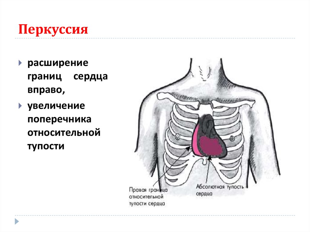 Границы расширены влево. Поперечник относительной тупости сердца в норме. Границы относительной сердечной тупости расширены влево. Перкуссия сердца границы относительной сердечной тупости. Перкуторное расширение границ сердца.