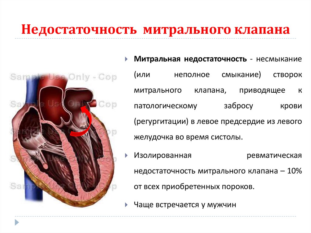 Поражение митрального клапана. Гипертрофия митрального клапана. Митральный клапан сердца недостаточность 1 степени. Недостаточностььмирального клапана недостаточность. Пороки сердца недостаточность митрального клапана.