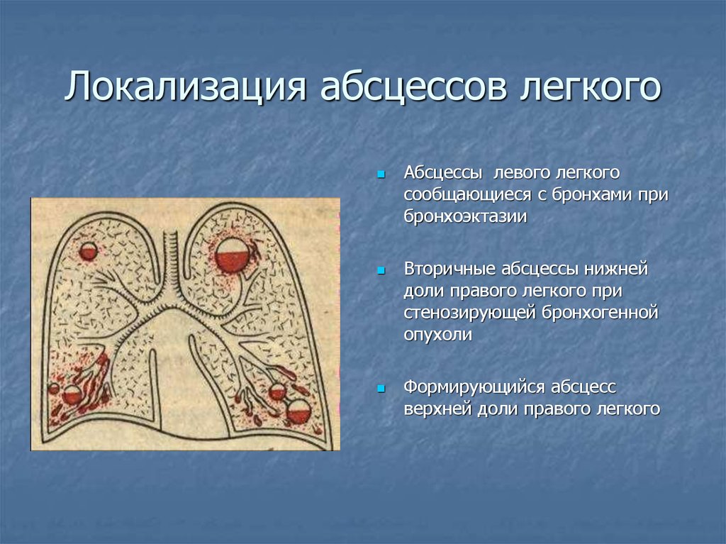 Реферат: Острый абсцесс и гангрена легких