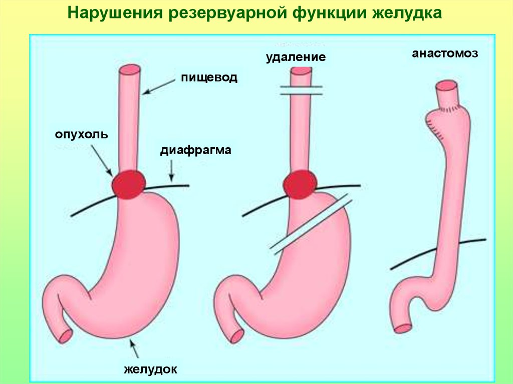 Операция желудка кишечника. Эзофагеальный анастомоз. Резекция желудка анастомозы.