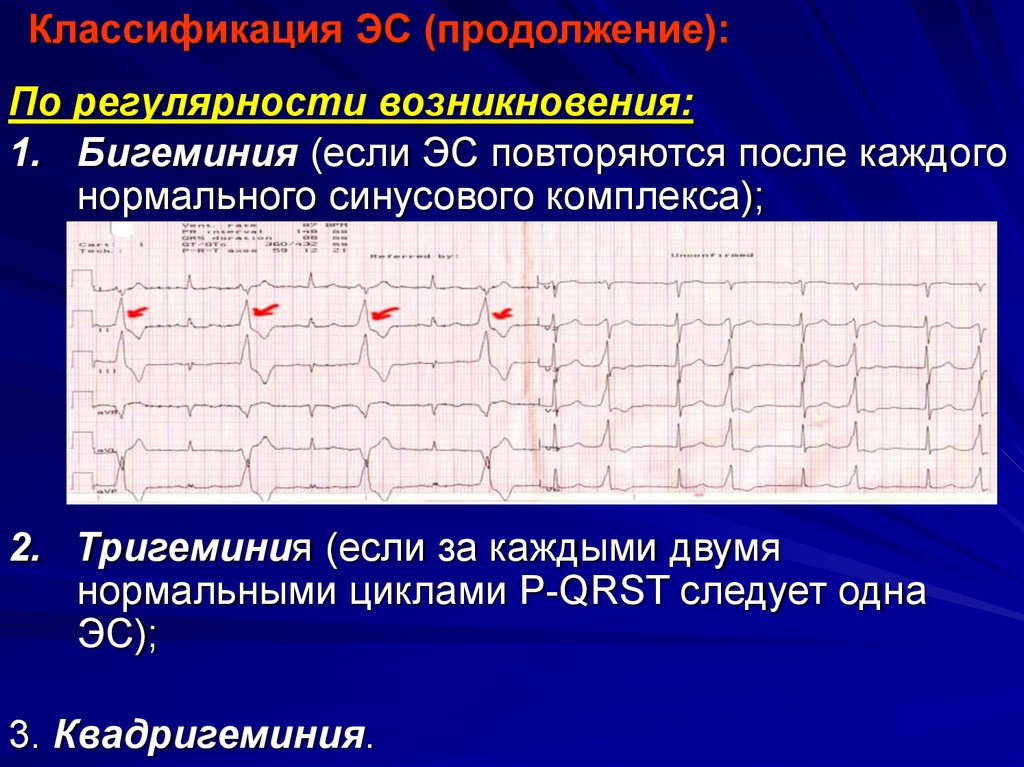 Желудочковая экстрасистолия карта вызова