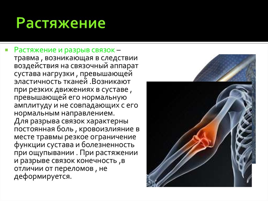 Растяжение это. Растяжение осложнения. Механизм образования растяжения. Растяжение клиническая картина.