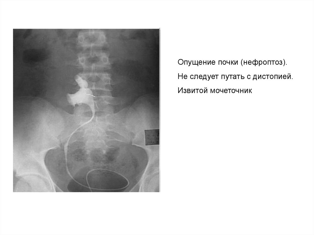 Дистопия почки. Подвздошная дистопия почки рентген. Тазовая дистопия почки рентген. Поясничная дистопия почки рентген. Экскреторная урография дистопия.