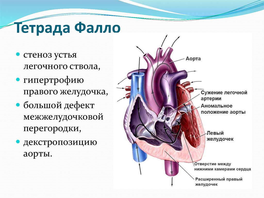 Тетрада фалло схема