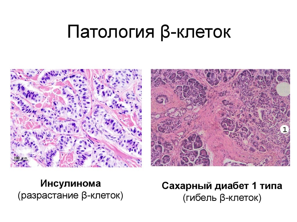 Сахарный диабет патанатомия презентация