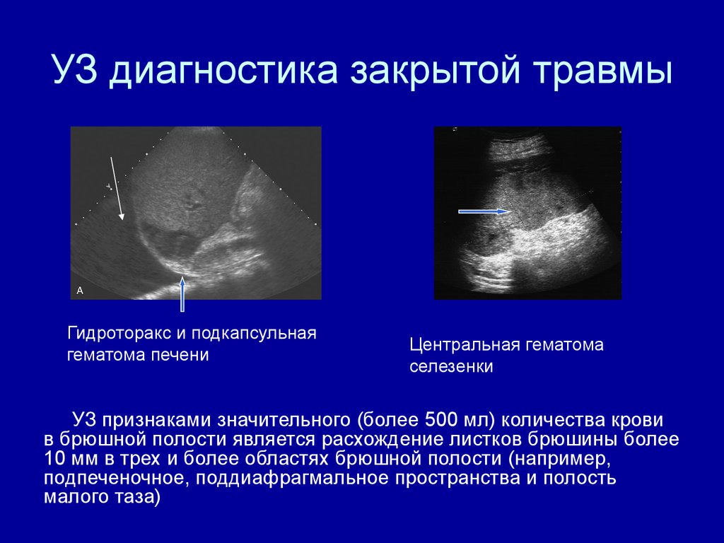 Уз признаки. Подкапсульная гематома печени на УЗИ. Закрытая травма селезенка на УЗИ. Субкапсулярная гематома селезенки УЗИ. Подкапсульный разрыв селезенки на УЗИ.