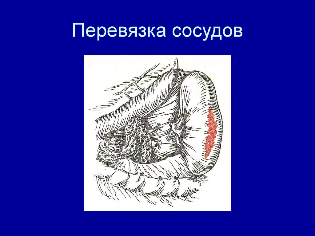 Перевязка в ране и на протяжении. Перевязка крупных сосудов. Перевязка сосуда на протяжении. Перевязка (лигирование) сосуда.