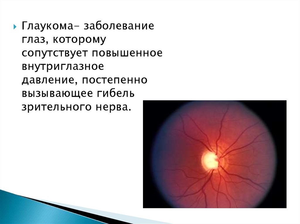 Что нельзя делать при глаукоме. Глаукома причины возникновения.