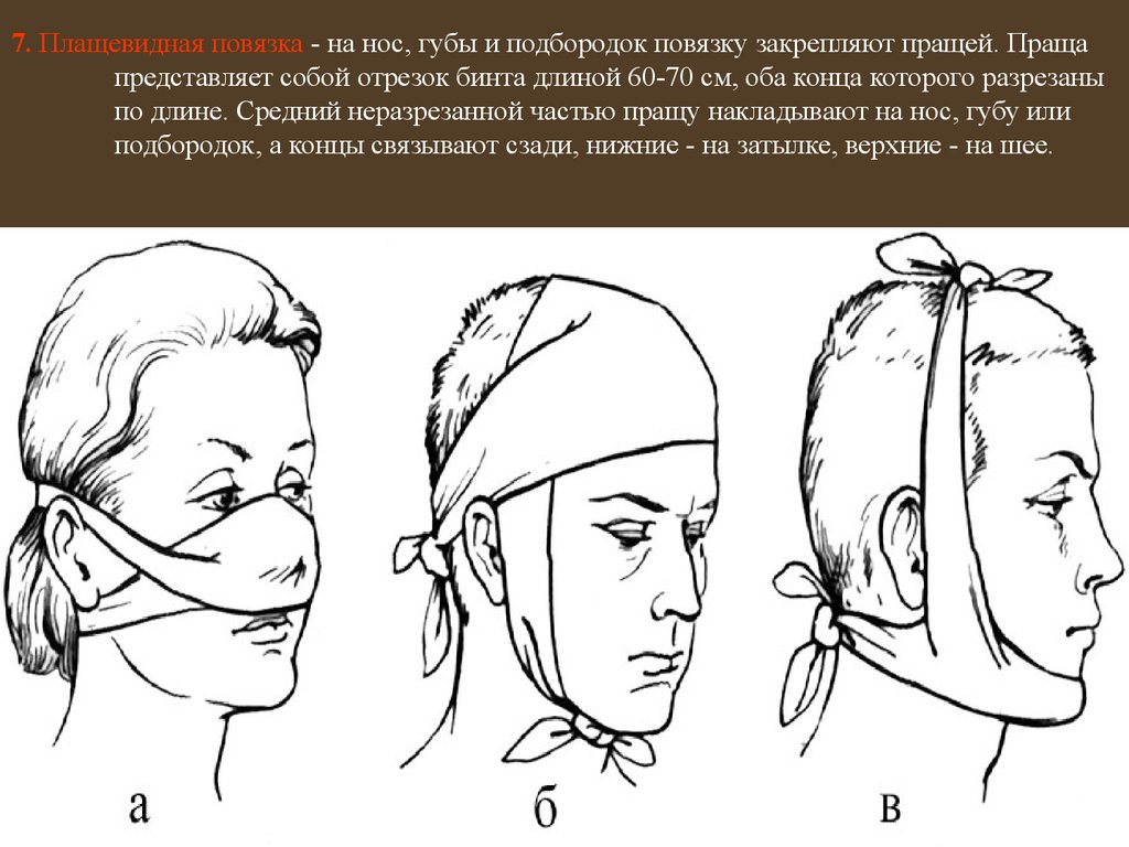 7. Плащевидная повязка - на нос, губы и подбородок повязку закрепляют пращей. Праща представляет собой отрезок бинта длиной 60-70 см, оба конца 