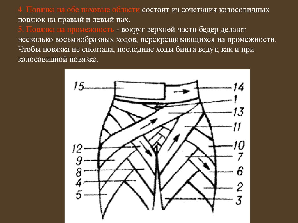 4. Повязка на обе паховые области состоит из сочетания колосовидных повязок на правый и левый пах. 5. Повязка на промежность - вокруг верхней 