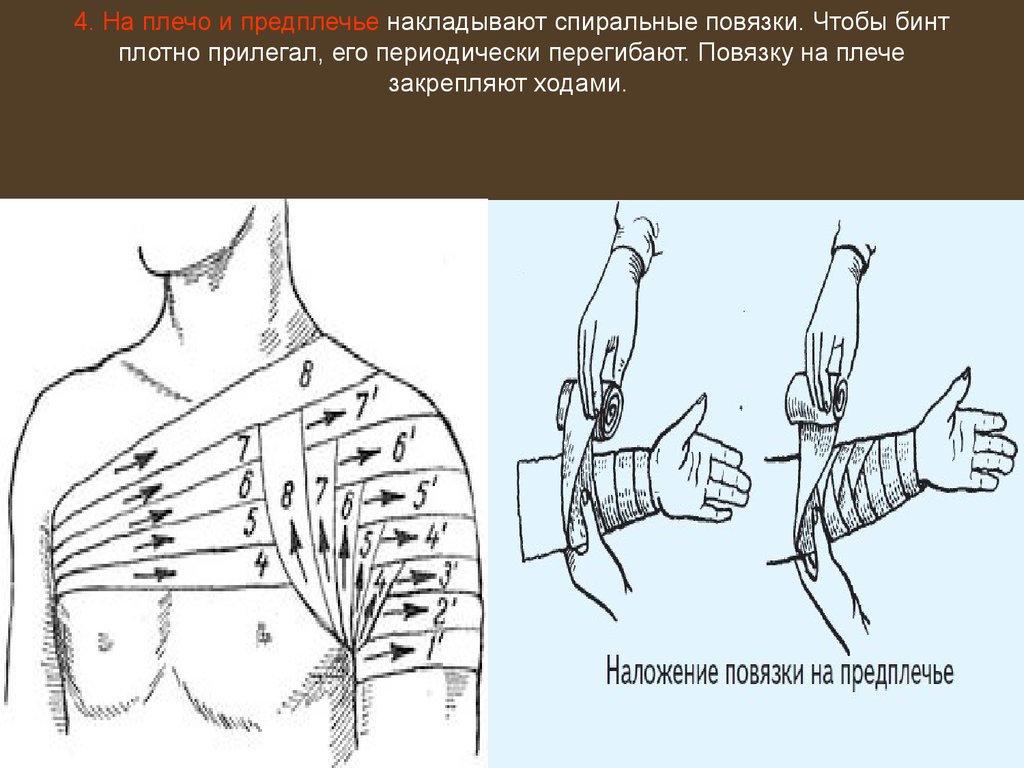 Спиральная с перегибами. Алгоритм наложения спиралевидной повязки на предплечье.. Спиральная повязка на плечо и предплечье. Спиральная бинтовая повязка. Спиральная повязка накладывается.