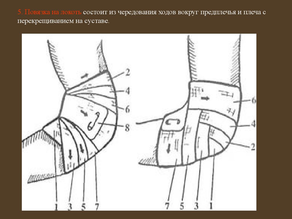 Повязка на локоть. Спиральная повязка на локтевой сустав. Черепашья повязка на локтевой сустав алгоритм. Колосовидная повязка на локтевой сустав. Повязка на локтевой сустав бинтом.