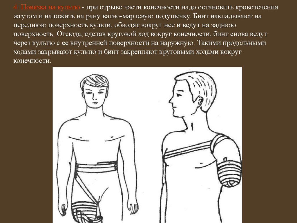 4. Повязка на культю - при отрыве части конечности надо остановить кровотечения жгутом и наложить на рану ватно-марлевую подушечку. Бинт нак