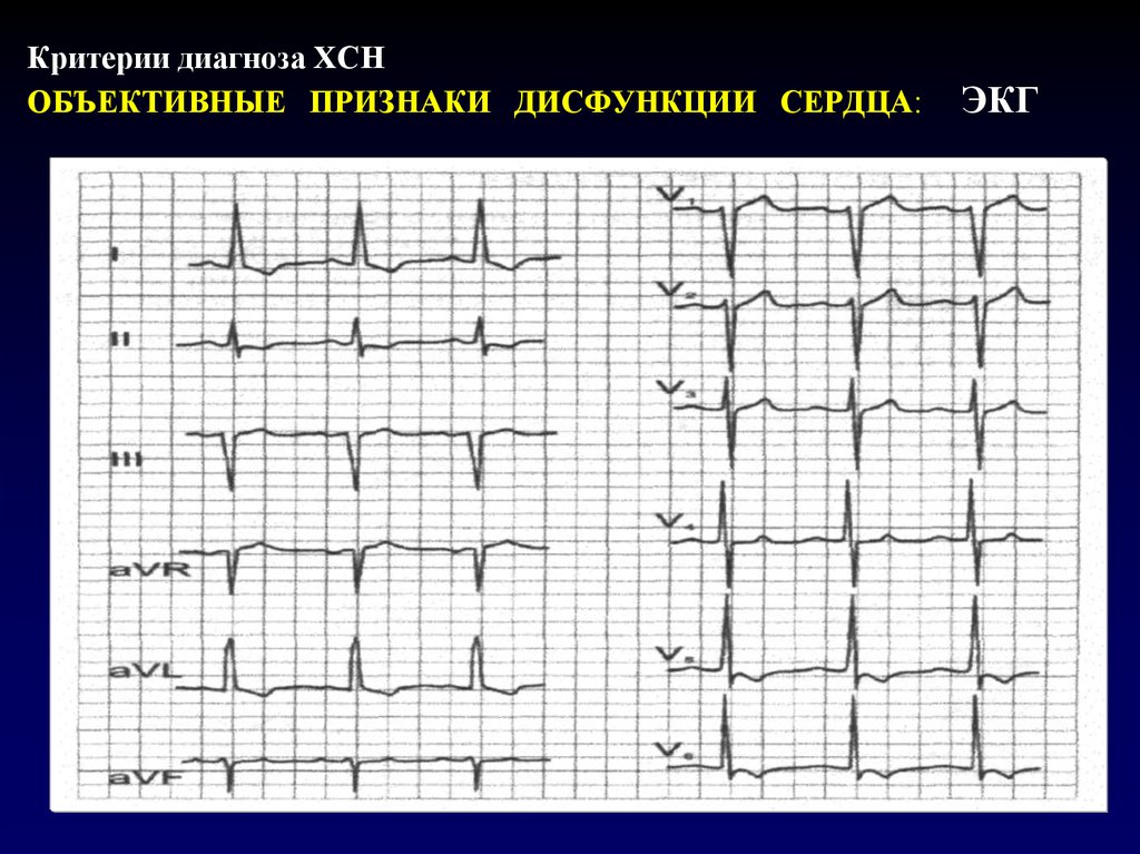 Что показывает экг. ЭКГ при сердечной недостаточности 2а. ЭКГ при острой сердечной недостаточности. Признаки ХСН на ЭКГ. ЭКГ при ХСН 2б.