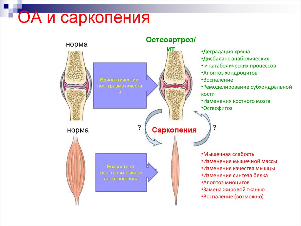 Саркопения что это такое симптомы лечение у женщин препараты схема лечения