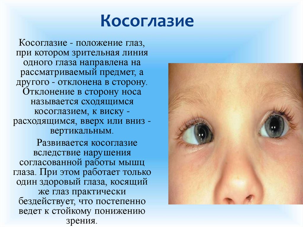 Косит глаз причины. Косоглазие. Заболевания косоглазие. Эзотропия сходящееся косоглазие. Косоглазие развивается при поражении.