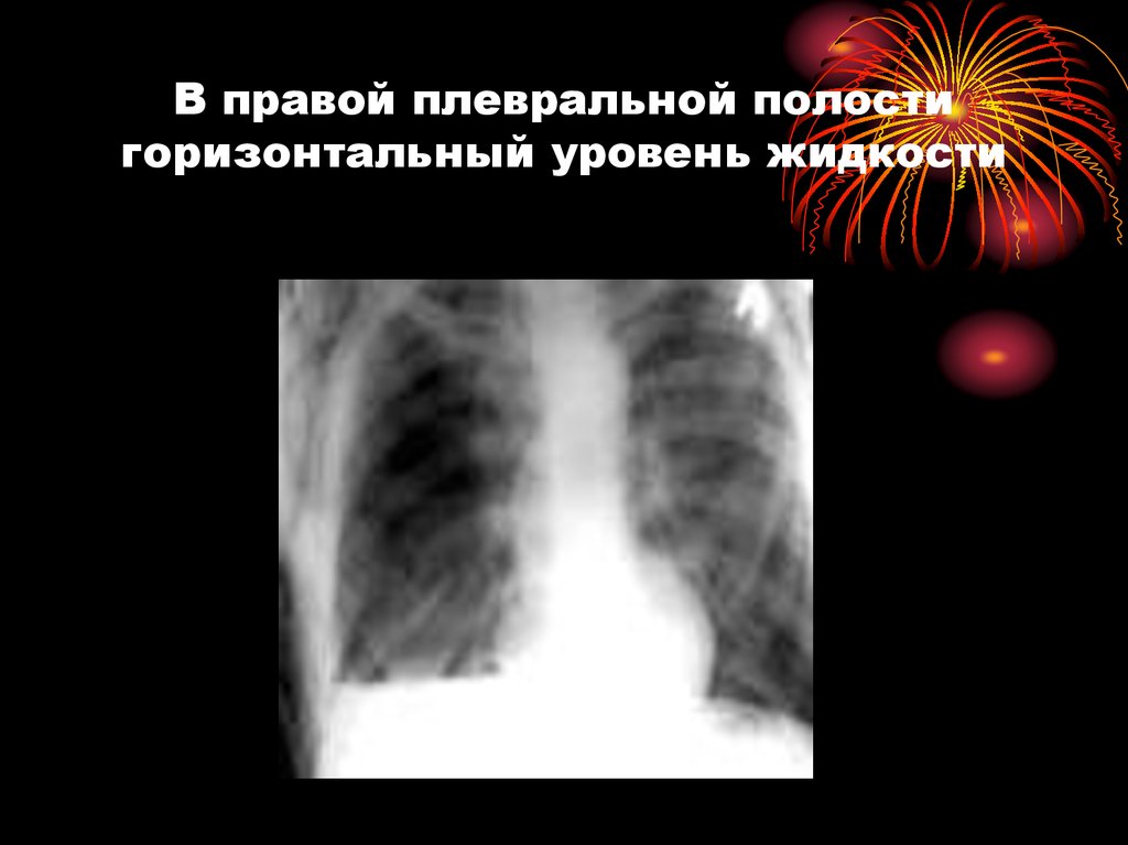 Жидкость в плевральной полости. Жидкость в правой плевральной полости. Горизонтальный уровень жидкости на рентгене. Плеврит жидкость в плевральной полости. Горизонтальный уровень жидкости при гидротораксе.