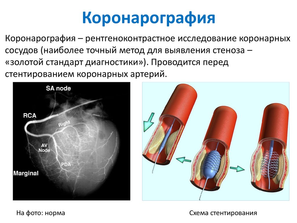 Операция через сосуды. Коронарное исследование сосудов сердца. Ангиография коронарных сосудов. Коронарография ишемия. Обследование сосудов сердца коронарография.