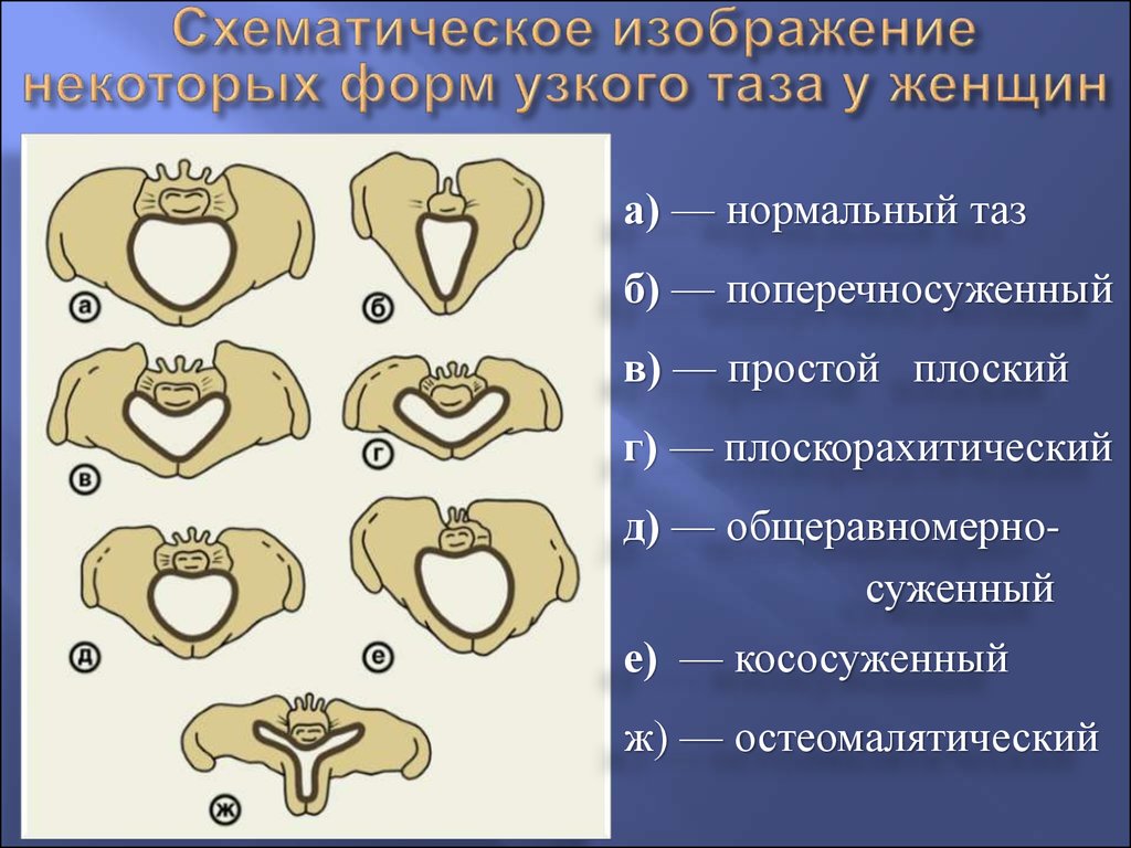 Узкий таз в акушерстве презентация