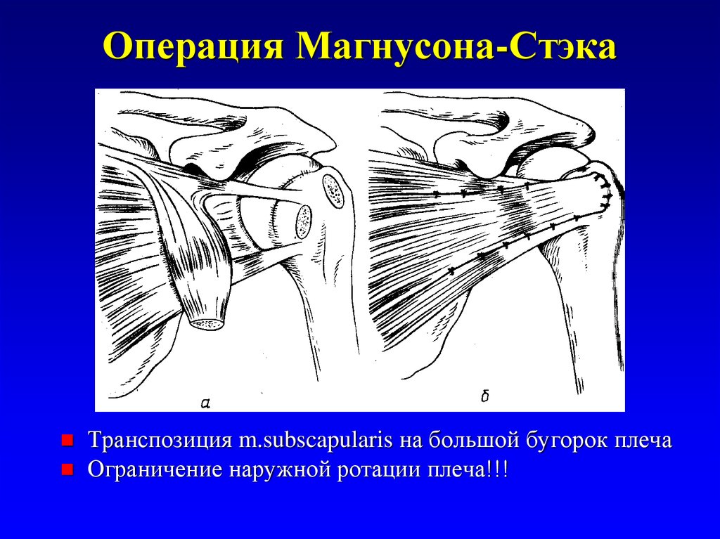 Вывих плеча. Операция при привычном вывихе плечевого сустава по. Операция привычного вывиха плеча по Краснову. Операции при привычном вывихе плечевой кости. Привычный вывих плеча операция Бойчев.