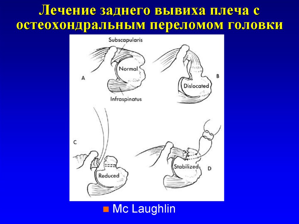 Лечение заднего. Задний вывих головки плеча. Задний вывих плеча лечение.