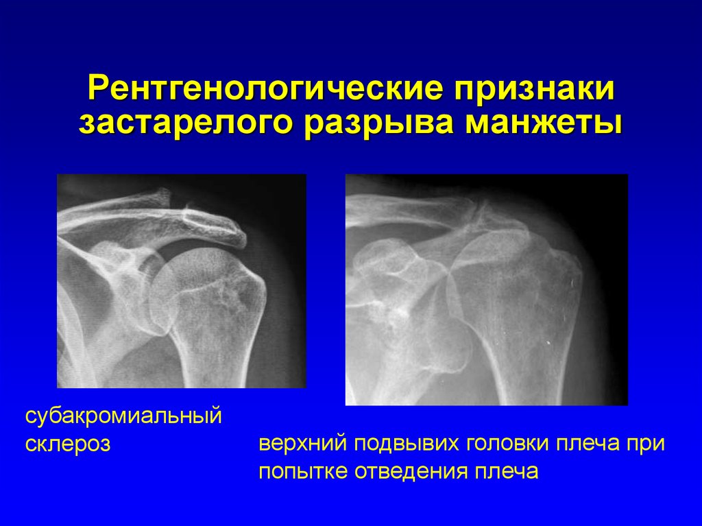 Вывихи плечевого сустава презентация